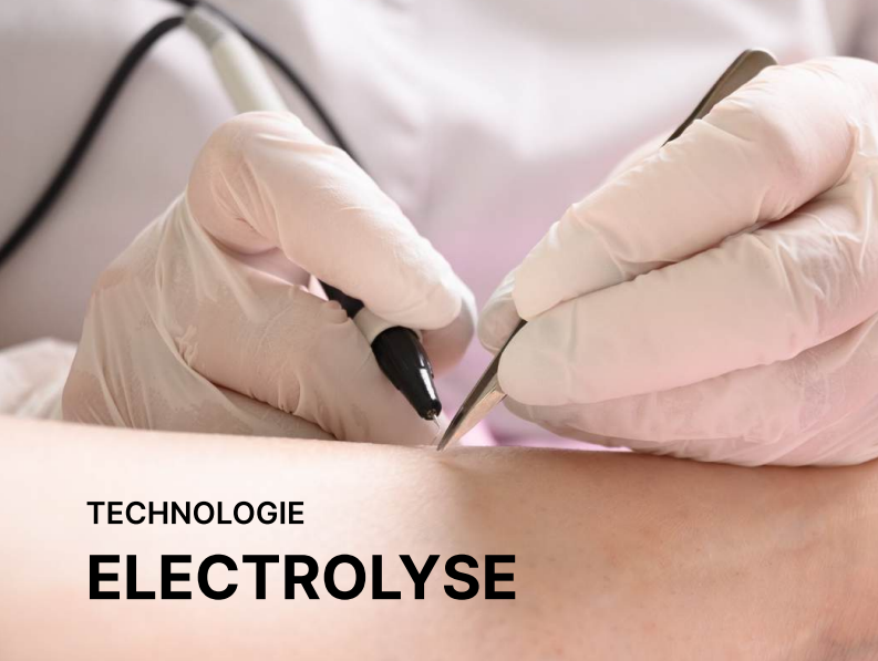 photo-épilation-laser-nouveauté