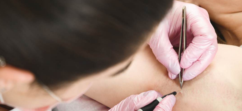 image-épilation-laser